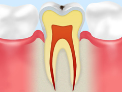 【CO】 歯の表面の脱灰