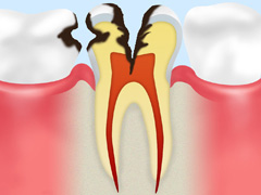 【C3】神経にまでおよんだ虫歯