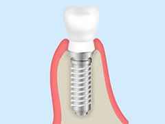 インプラント治療