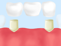 インプラント治療