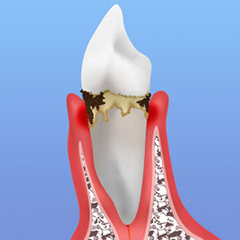 歯周炎（軽度）